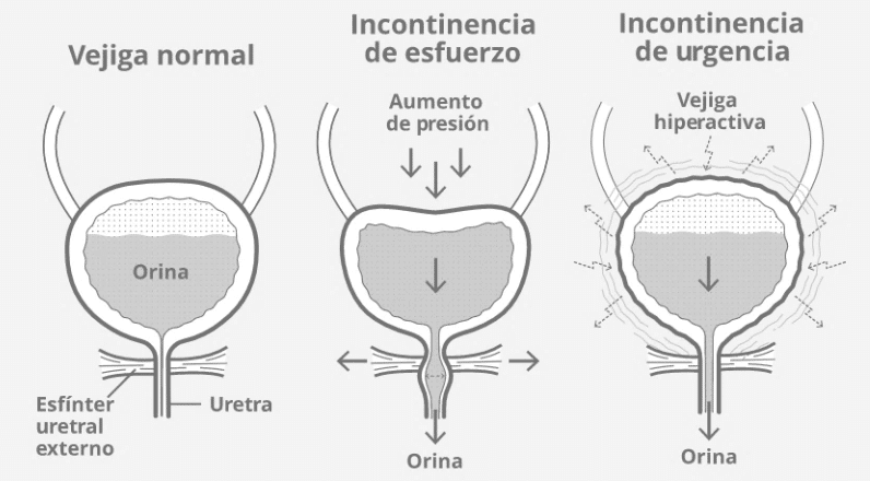 Explicacion Y Sus Tipos Basados En La Incontinencia Urinaria Donde Images